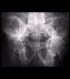 Figure 4: Paget's disease of the pelvis. The bone is thick, wide and patchy.