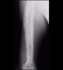 Figure 5: Paget's disease of the humerus. Note how dense and wide the bone is. It is also patchy from areas of active bone turnover.