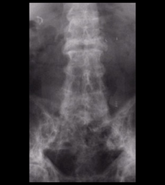 Figure 3: Paget's disease of the spine. The white, patchy appearance of the bone on this X-ray is characteristic of the dense but disordered bone in this disease.