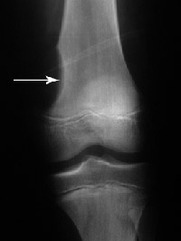 xray of tumor
