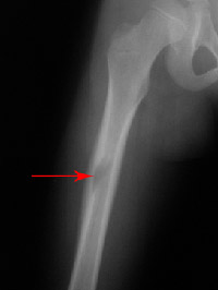 xray of bone tumor