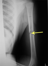 Xray of fracture through a tumor