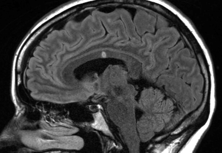 susac syndrome scan